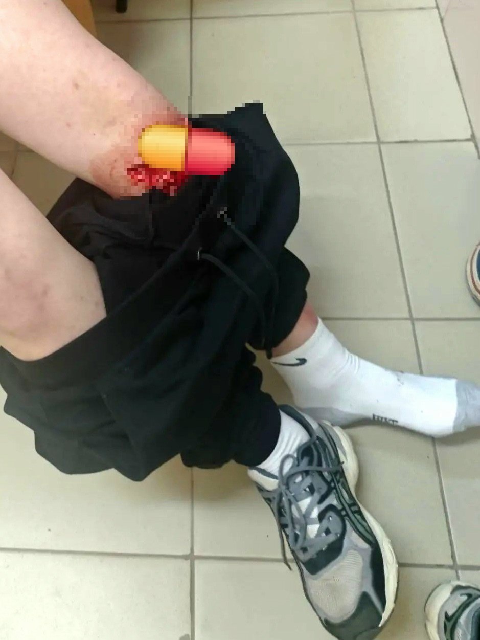 Площадка с ловушкой: в селе Сарафоново из‑за прогнивших досок пострадал ребёнок